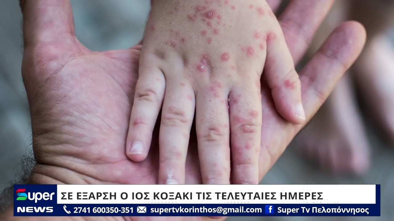 Ιατρικός Σύλλογος Λάρισας – Ιδιώτες Παιδίατροι: Σε έξαρση κρούσματα του ιού Κοξάκι