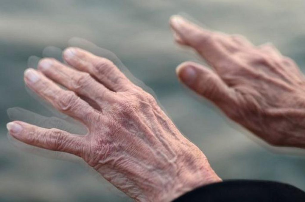 Στ. Χατζηγεωργίου, νευρολόγος: Ανησυχητική η αύξηση πάρκινσον στη Θεσσαλία-(video)
