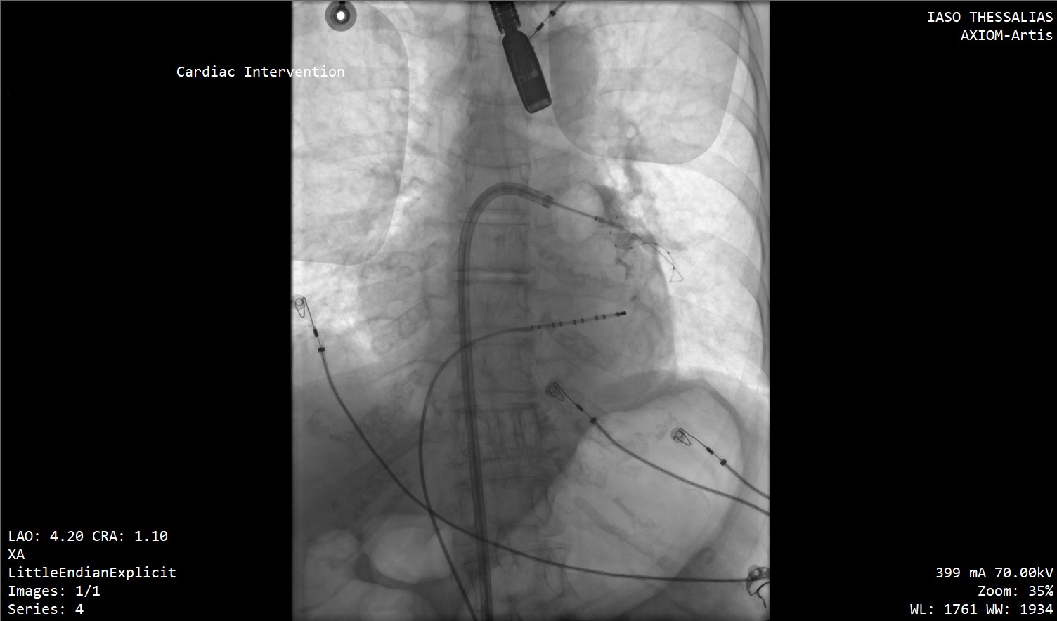 Οι πρώτες επεμβάσεις κατάλυσης με καθετήρες (ablation) για την κολπική μαρμαρυγή στην Κεντρική Ελλάδα  στο ΙΑΣΩ Θεσσαλίας