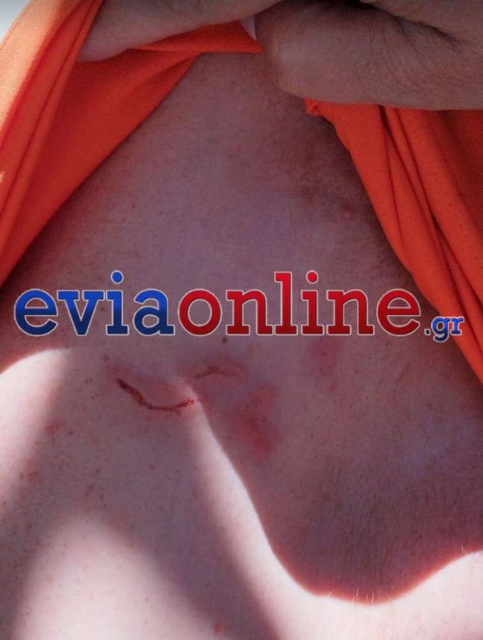 Επέλαση από μωβ μέδουσες στην Εύβοια -«Ο πόνος ήταν αφόρητος», περιγράφει λουόμενος που δέχτηκε τσίμπημά τους