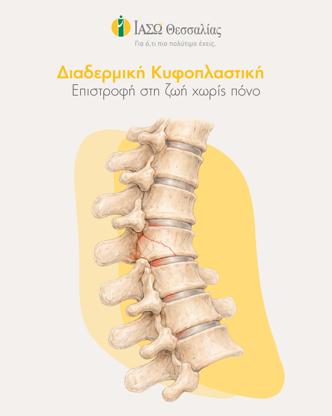 ΙΑΣΩ Θεσσαλίας: ΔΙΑΔΕΡΜΙΚΗ ΚΥΦΟΠΛΑΣΤΙΚΗ-  Λύση χωρίς ανοικτό   χειρουργείο για το κάταγμα σπονδύλου (φωτο)