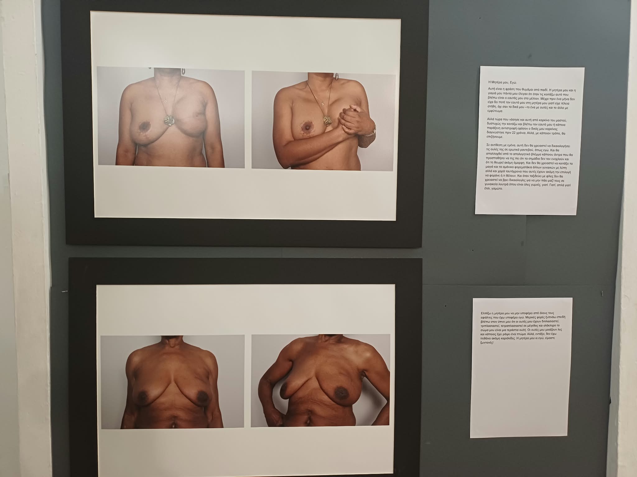 «boobs – art for awareness» στη Λάρισα: Όταν η τέχνη μιλά ανοιχτά για το σώμα και τον καρκίνο του μαστού (ΦΩΤΟ)