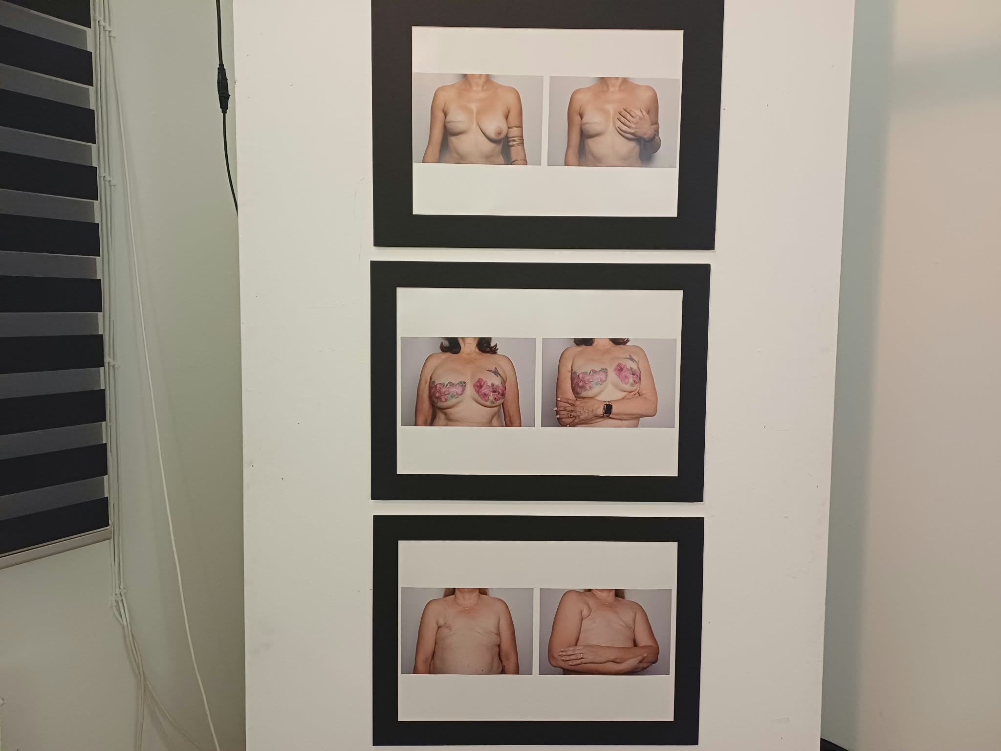 «boobs – art for awareness» στη Λάρισα: Όταν η τέχνη μιλά ανοιχτά για το σώμα και τον καρκίνο του μαστού (ΦΩΤΟ)